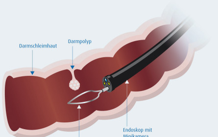 Debatte über Vorsorgekosten