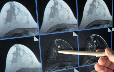 Brustkrebs-Forschung