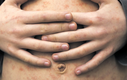 Die Masern sind wieder da