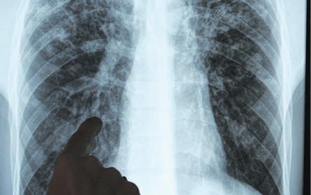 WHO besorgt: Tuberkulose auf Vormarsch 
